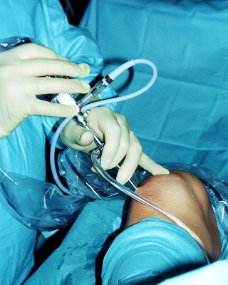 Operation am Knie Operation bei Gonarthrose