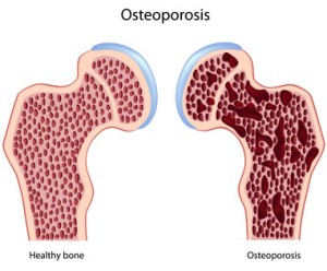 Osteoporose betrifft vor allem ältere Frauen.
